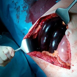 Ileus from a surgical viewpoint