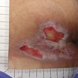 Non-healing wound care