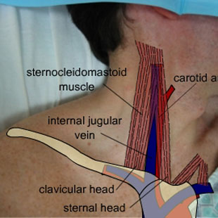 Invazivní zajištění kriticky nemocného pacienta – centrální žilní katétr Anotační obrázek