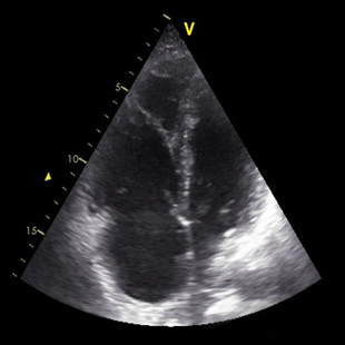 Anaphylaxis in obstetrics - amniotic fluid embolism Annotation image