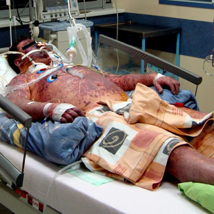 Meningococcal sepsis