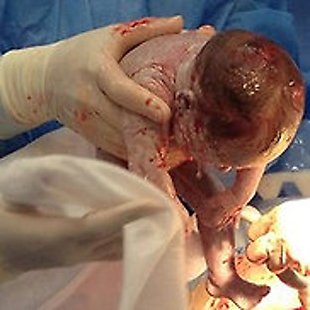 Caesarean section Annotation image