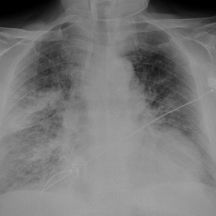 Pulmonary oedema Annotation image