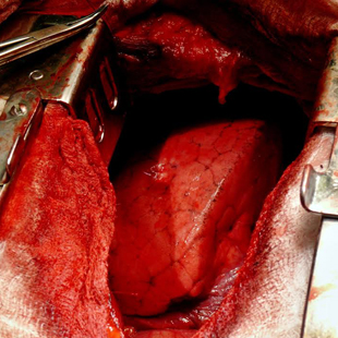 Anestezie u hrudních operací Anotační obrázek
