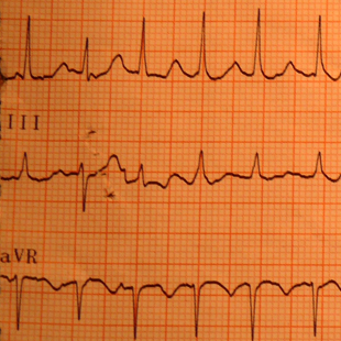 Management of tachyarrythmia