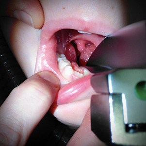 Tonsilektomie u dětí Anotační obrázek