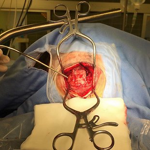 Peroperative embolism Annotation image