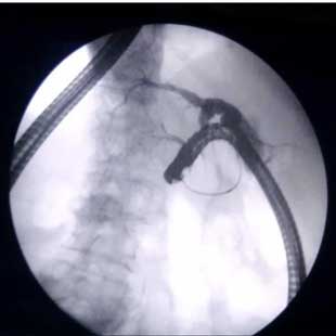 Acute pancreatitis Annotation image