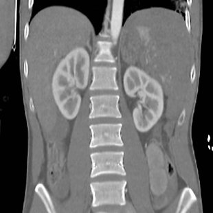 Traumatic life-threatening hemmorhage