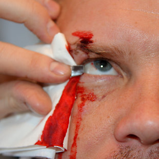Penetrating eye injury Annotation image