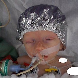 Anestezie novorozence Anotační obrázek