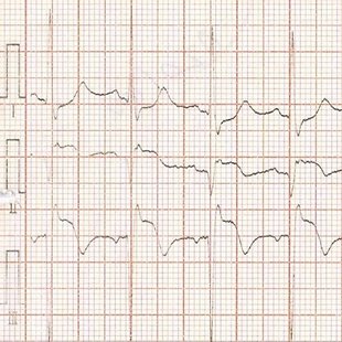 Acute coronary syndrome - 2018 Annotation image