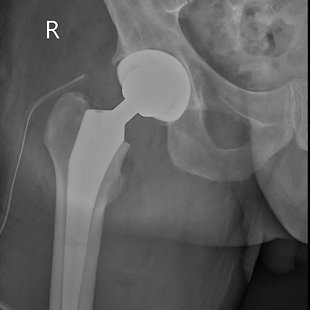 Anaesthetic Management in THA Annotation image