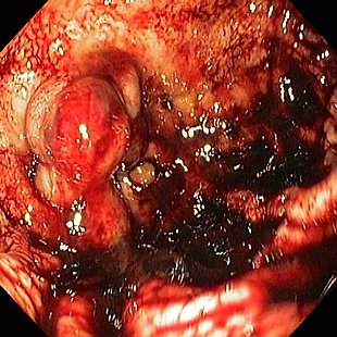 Life-threatening Bleeding - 2018 Annotation image