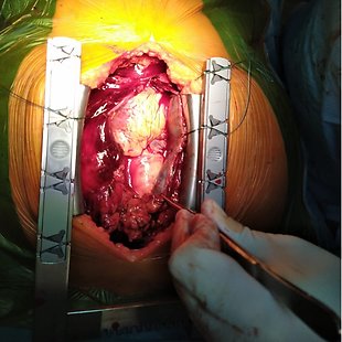 Pericardial tamponade Annotation image