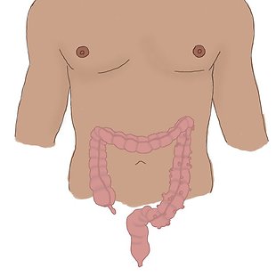 Intraabdominal infection and acute abdomen Annotation image