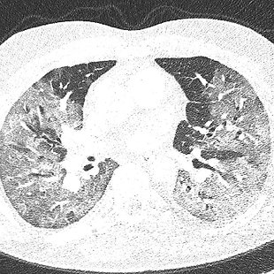 COVID-19 patient in the hospital Annotation image