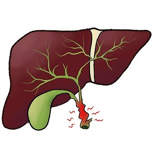 Cholangoitis Annotation image