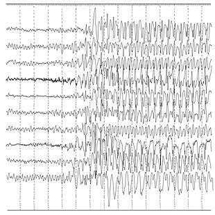 Refractory Seizures in Children