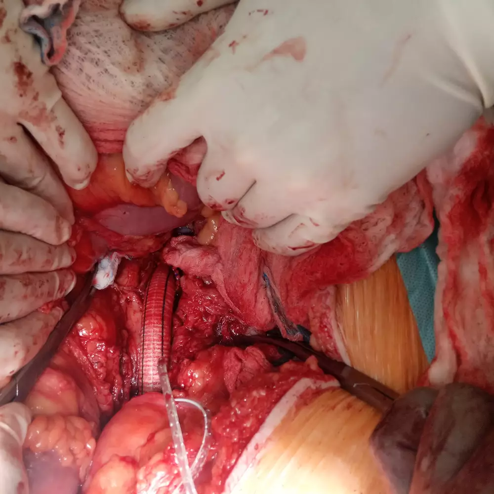 Elective abdominal aortic aneurysm repair Annotation image
