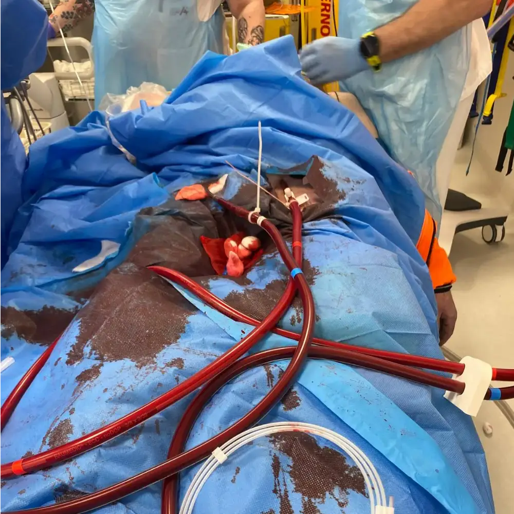 ECMO - KPR Anotační obrázek
